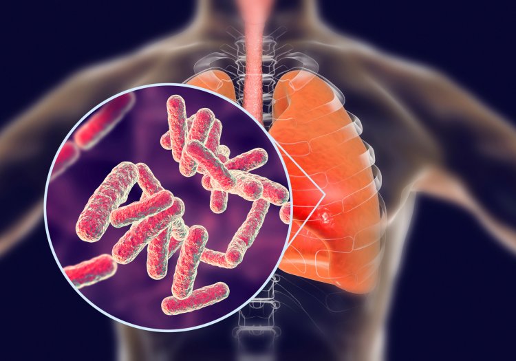 World TB Day: People with weak immunity are more victims of this disease, victims should take these precautions