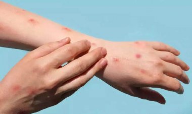 Monkeypox: WHO hears relief news about monkeypox, 21 percent drop in cases globally