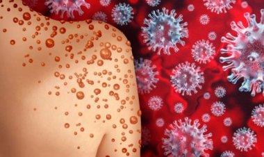 Monkeypox wreaks havoc in Germany, government will distribute more and more vaccines in the country