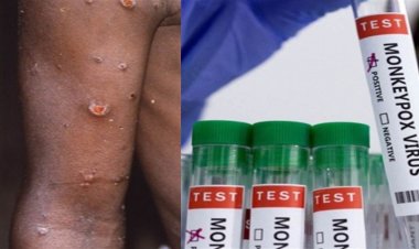 Monkeypox: Study finds antiviral tecovirimat safe and effective for treating monkeypox