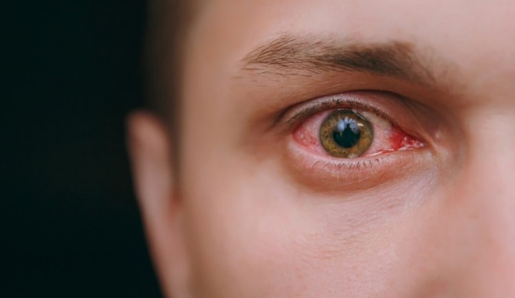 Red Eye Causes: Not only in conjunctivitis, eyes can become red and swollen in these 5 infections as well