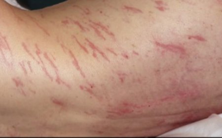 Worms seen crawling inside the skin of the sweeper in Spain, doctors were shocked, read the whole matter