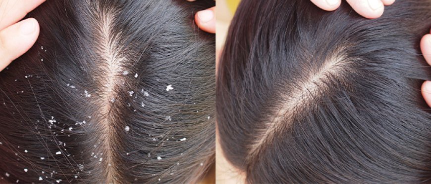 Dandruff Home Remedies: You often feel embarrassed due to dandruff, so adopt these 5 home remedies today itself.