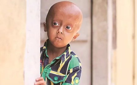 A man suffering from 'progeria' died at the age of 28, the young man had started aging prematurely