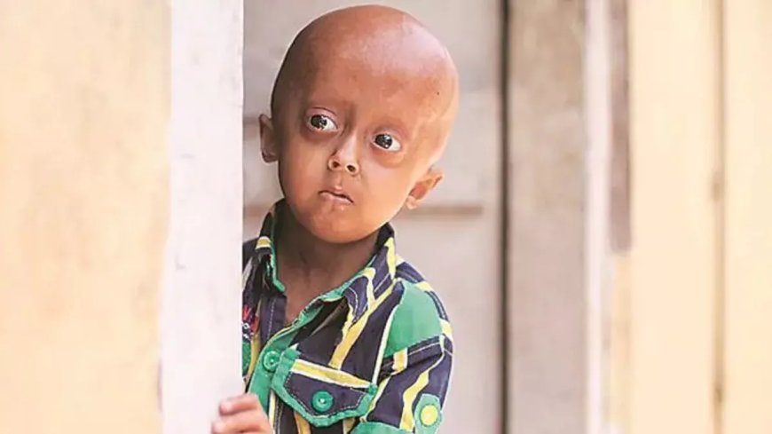 A man suffering from 'progeria' died at the age of 28, the young man had started aging prematurely